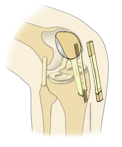 technique de ligamentoplastie au tendon rotulien pour rupture du lca kJ ligament kenneth jones